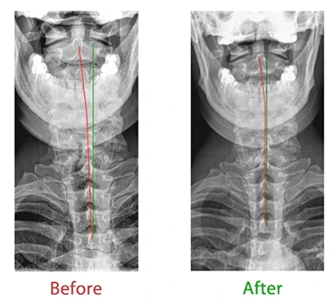 Chiropractic Lutz FL Neck X Ray