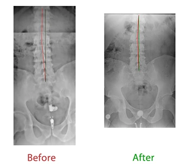 Chiropractic Lutz FL Spine X Ray