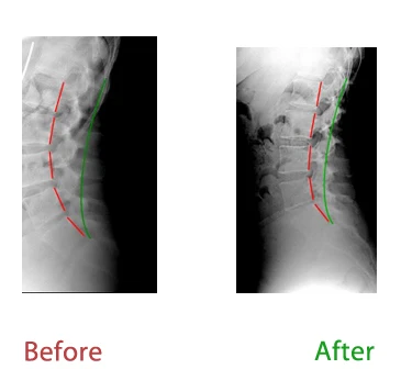 Chiropractic Lutz FL Straight Neck X Ray